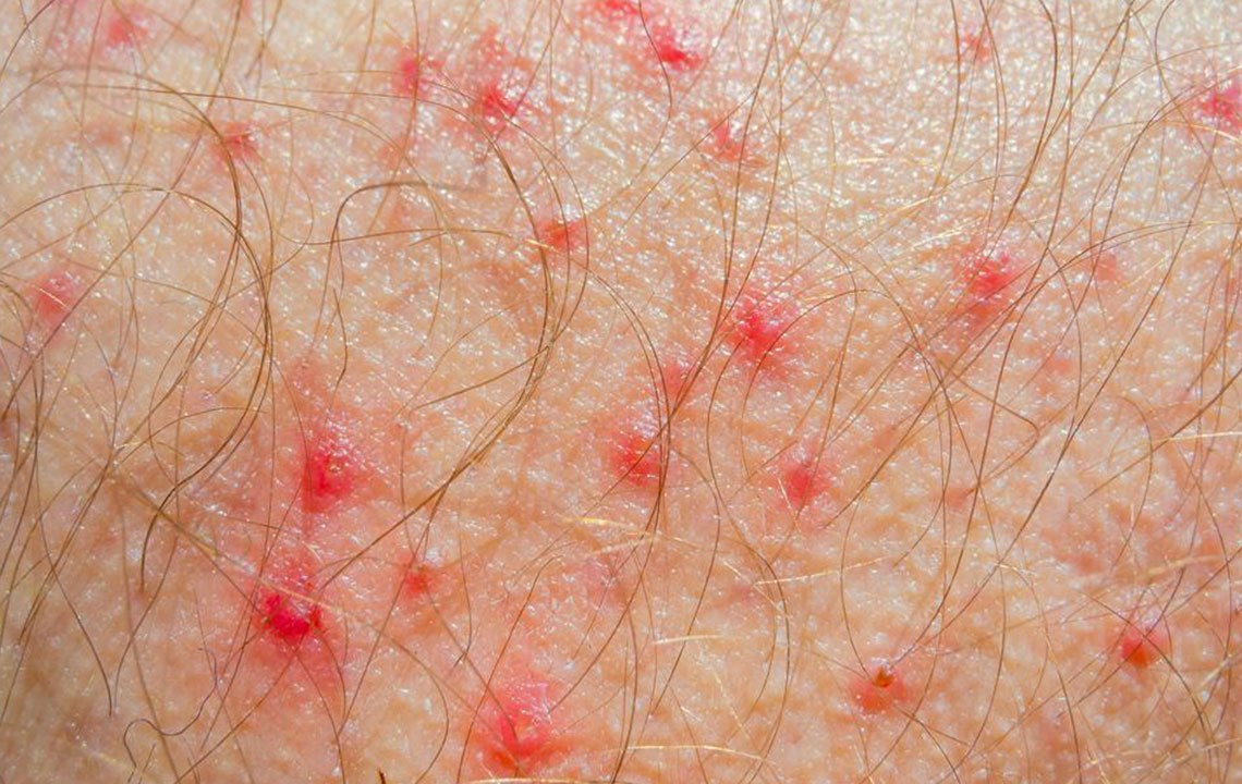 Know Everything about Atopic Dermatitis