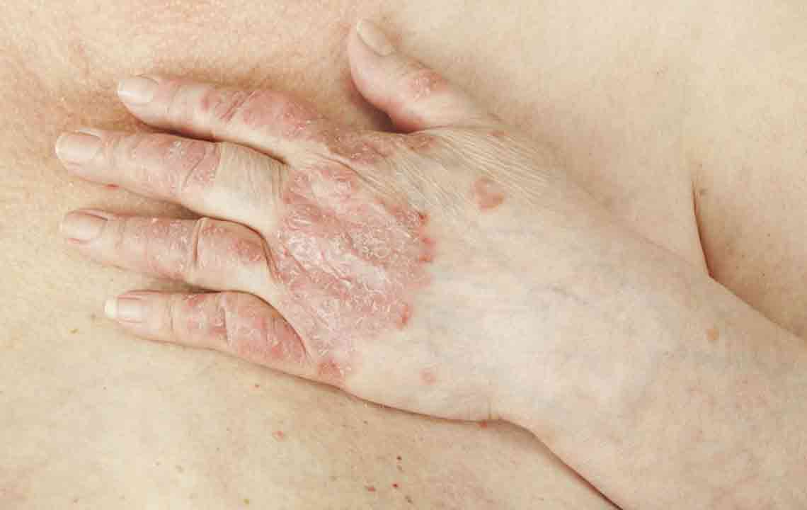 All the Information on Psoriasis You Need to Know