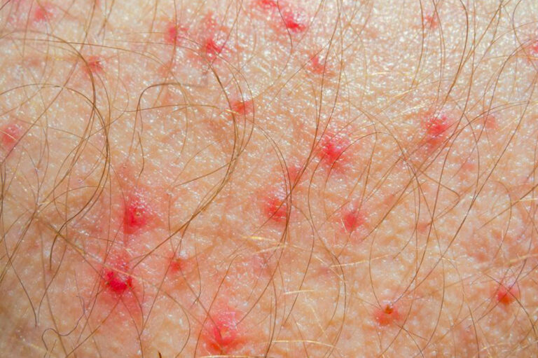 Know Everything about Atopic Dermatitis