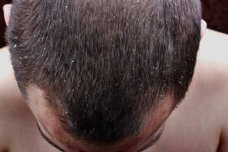 Scalp Psoriasis