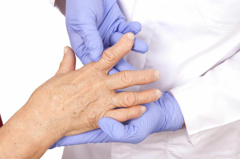 4 best remedies for rheumatoid arthritis 