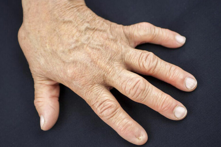 Signs of Rheumatoid Arthritis You Should Look out For