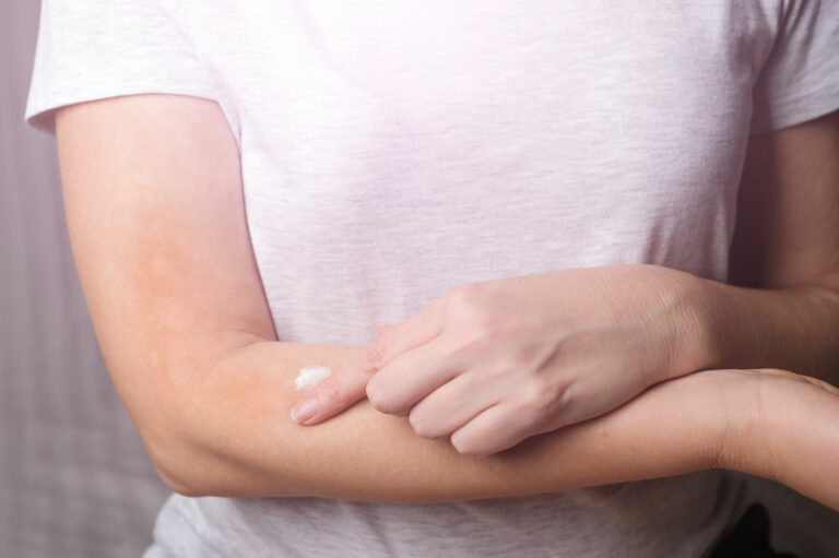 Itchy Skin &#8211; Best Anti-Itch Creams and Home Remedies