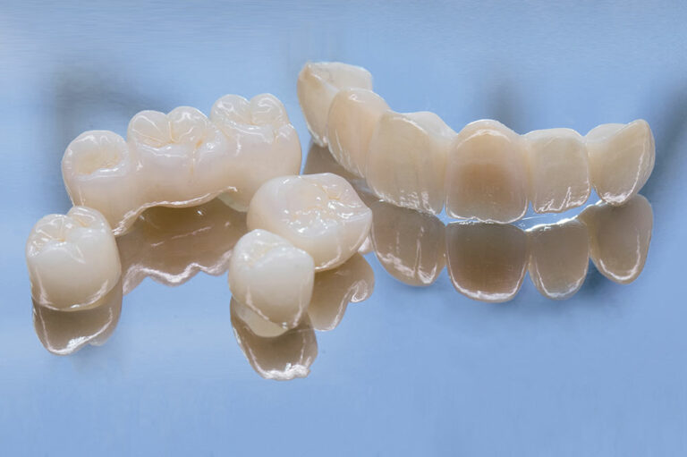 Things to Know Before Opting for Dental Bridges