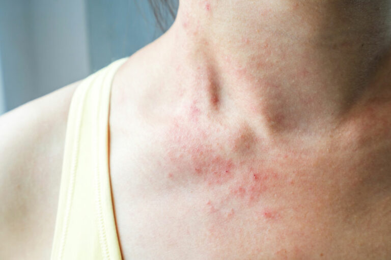 Mycosis fungoides &#8211; more than just a skin rash