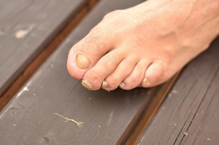 Most Beneficial Home Remedies for Toenail Fungus