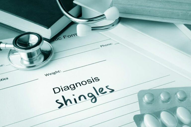 Natural Remedies for Shingles