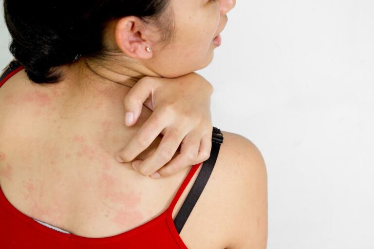 Atopic Dermatitis- Causes, Symptoms And Treatment