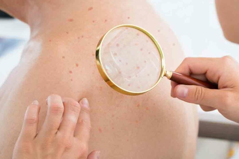 Atopic Dermatitis Eczema &#8211; Causes, Symptoms, and Treatments