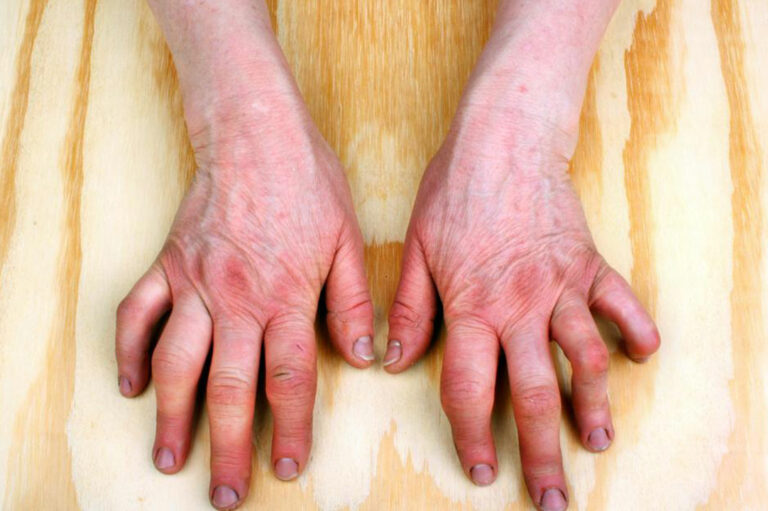 A Brief Overview of Rheumatoid Arthritis