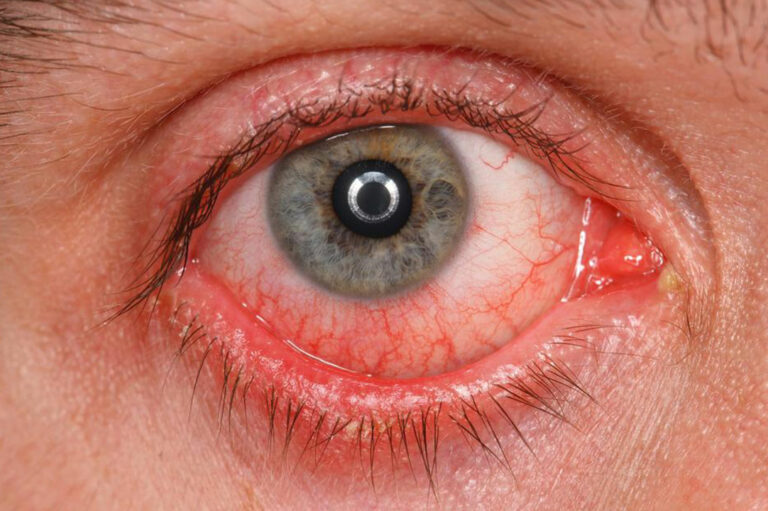 A Few Common Symptoms, Causes, And Treatments of Pink Eyes