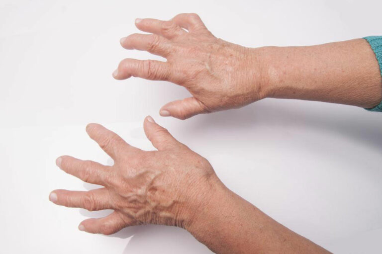 A Quick Guide of Rheumatoid Arthritis Drugs