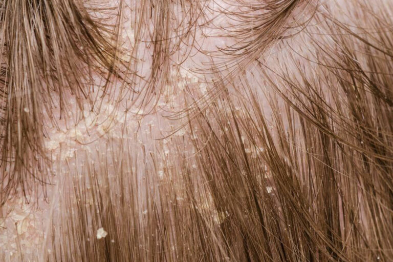 A brief overview of scalp psoriasis