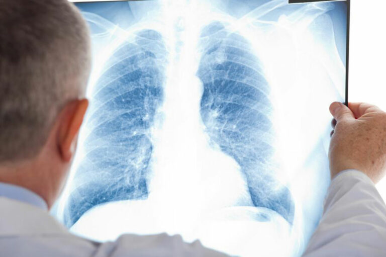 A few things you should know about mesothelioma cancer