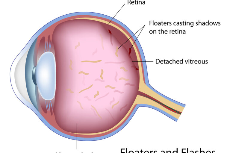 All About Eye Floaters And How To Get Rid Of Them