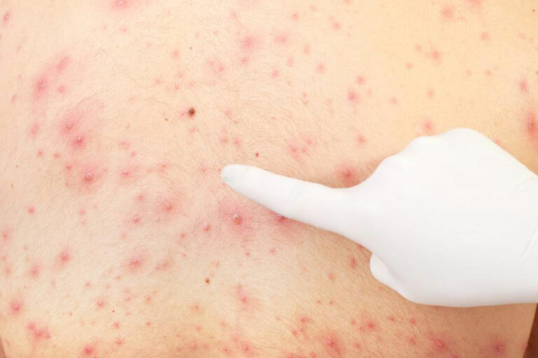 All You Need to Know About Pityriasis Rosea Treatments