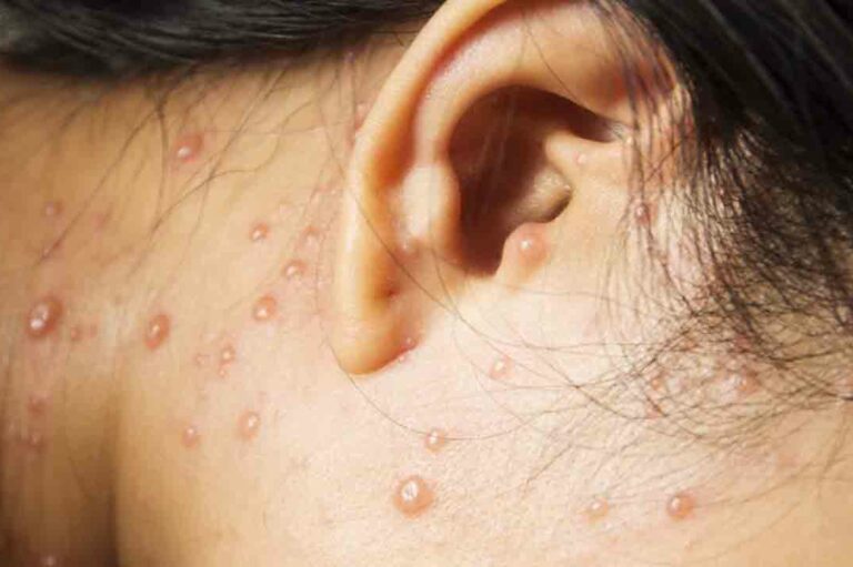 All You Need to Know About Shingles