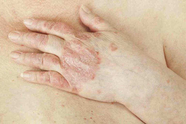 All the Information on Psoriasis You Need to Know