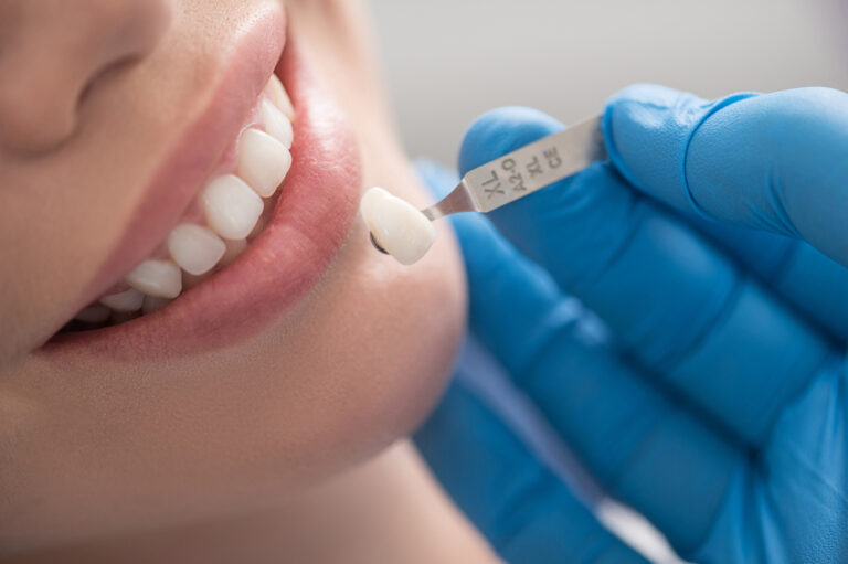 All you need to know about dental crowns and caps