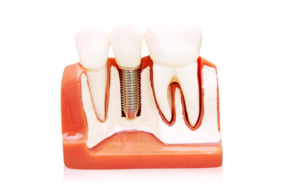 All you need to know about permanent dentures