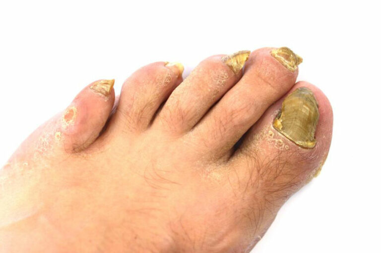 An Effective Way to Treat Toenail Fungus &#8211; Hydrogen Peroxide