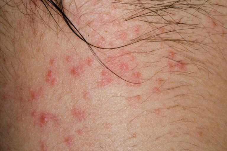 An Introduction to the Types of Itchy Skin Rashes