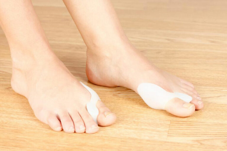 Bunion Treatment &#8211; All You Need to Know