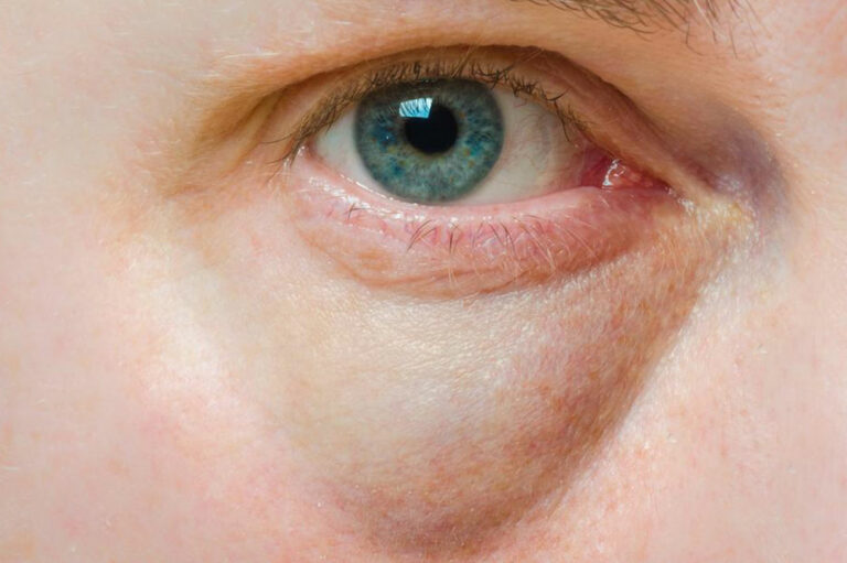 Bags Under the Eyes &#8211; Symptoms, Causes, and Treatment