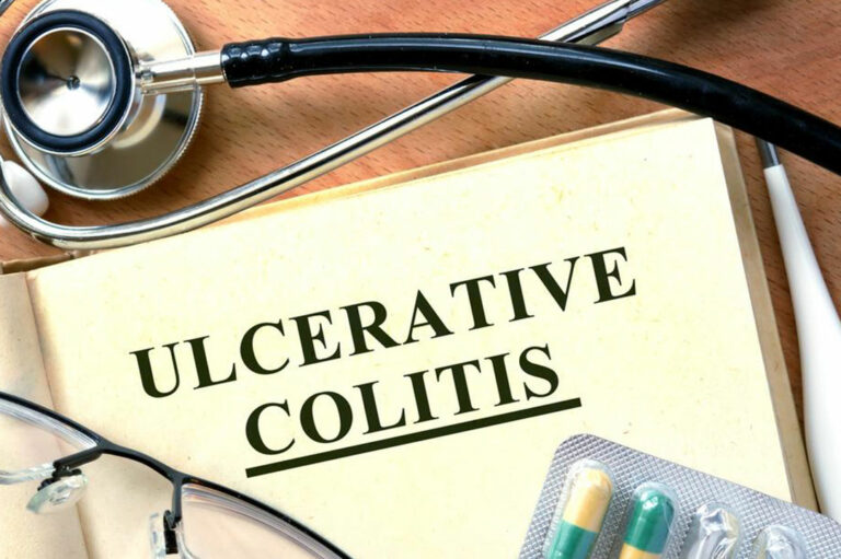 Beating Ulcerative Colitis Flares