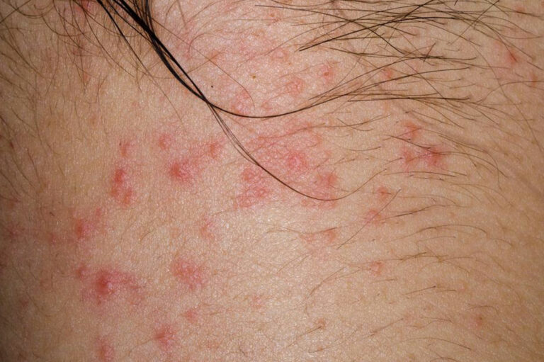 Curious about atopic dermatitis? Here&#8217;s what you need to know