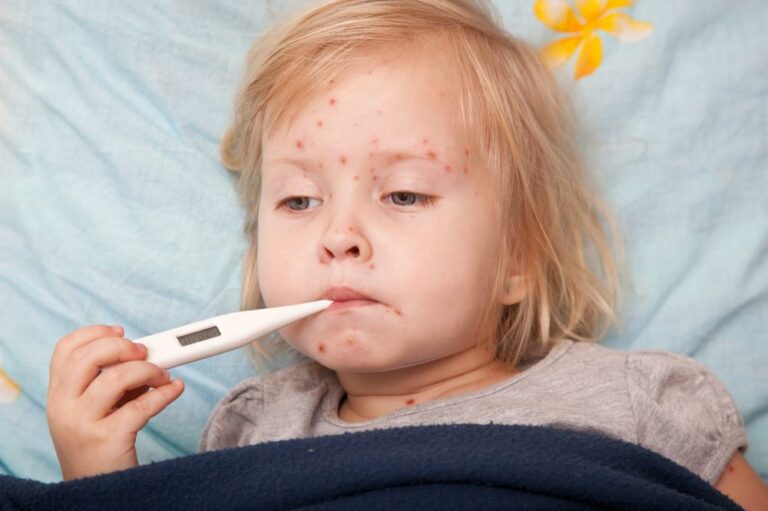 Causes, Symptoms, and Treatment of Measles