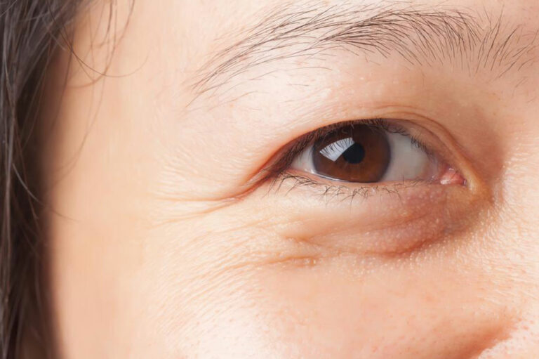 Causes of Under Eye Bags and Their Treatments