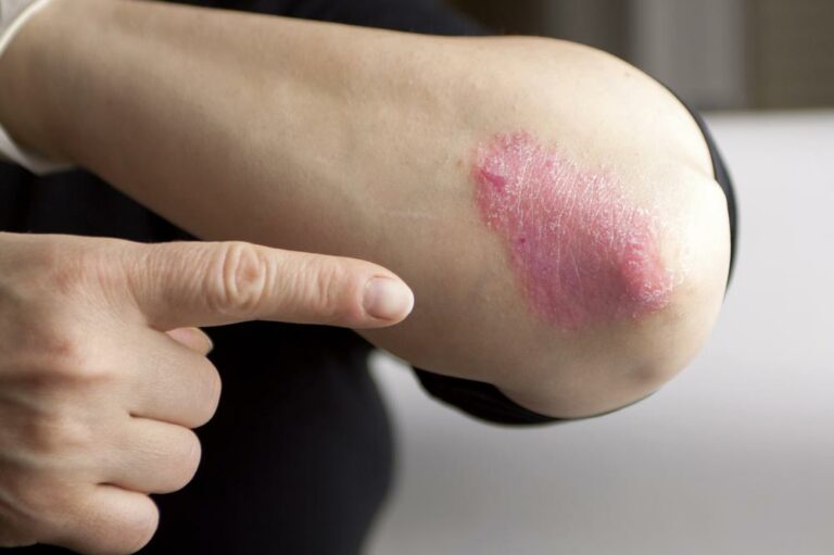 Causes of psoriasis that one needs to be aware of