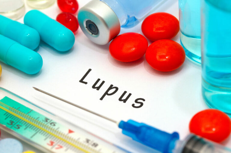 Causes and Symptoms of Lupus