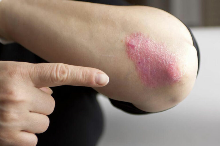 Chronic Plaque Psoriasis And its Effective Treatment