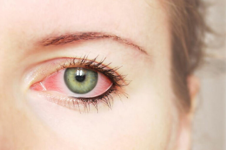 Common Causes and Treatments for Red Eye