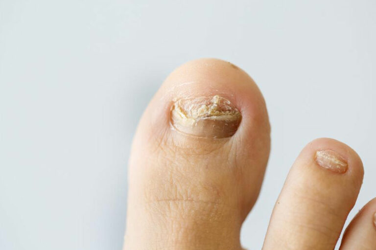 Common nail infections to avoid