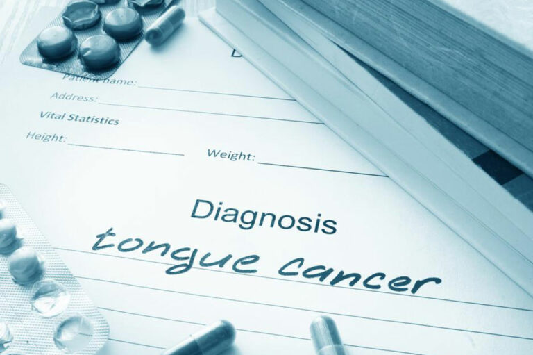 Common symptoms of tongue cancer