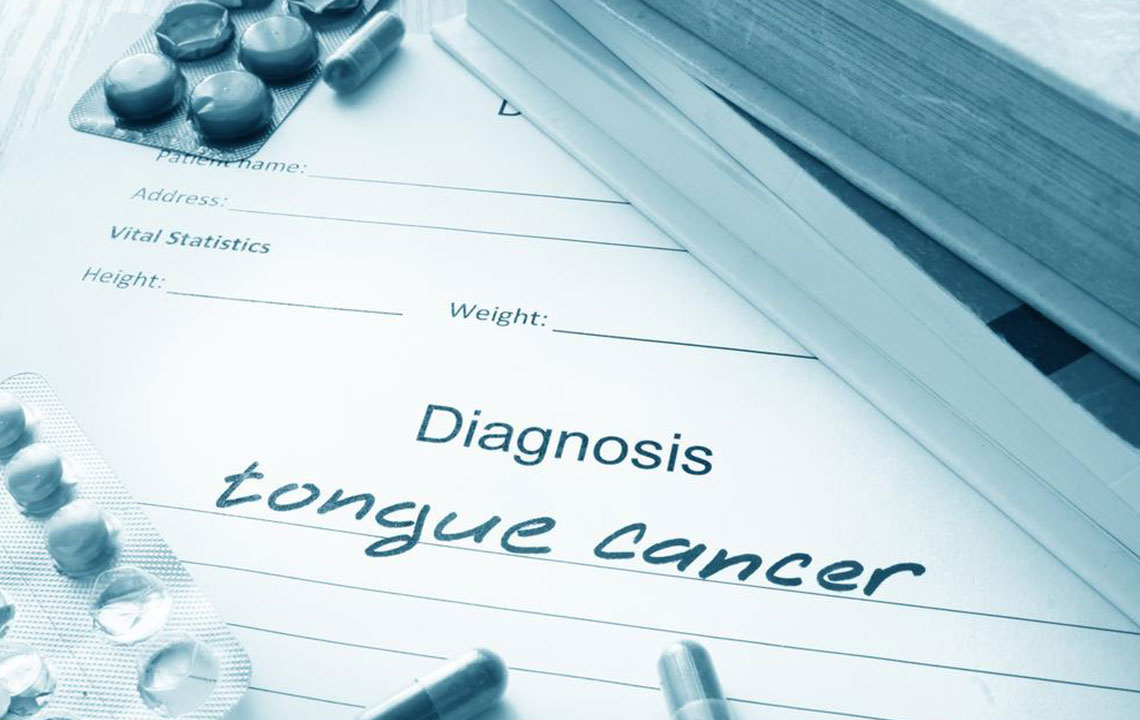 Common symptoms of tongue cancer