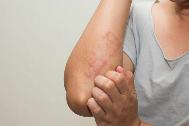 Dietary Changes and Tips to Cure Shingles Rash