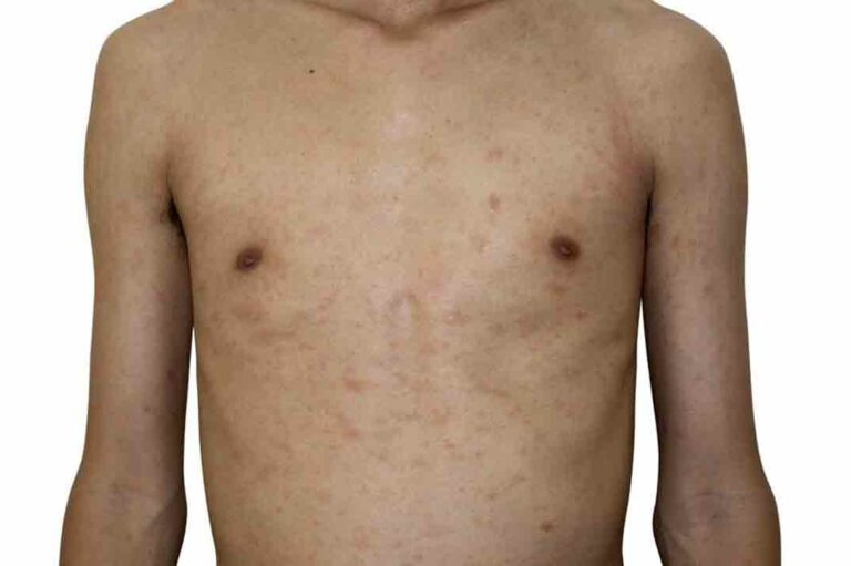 Different Types of Pityriasis Rosea Treatments