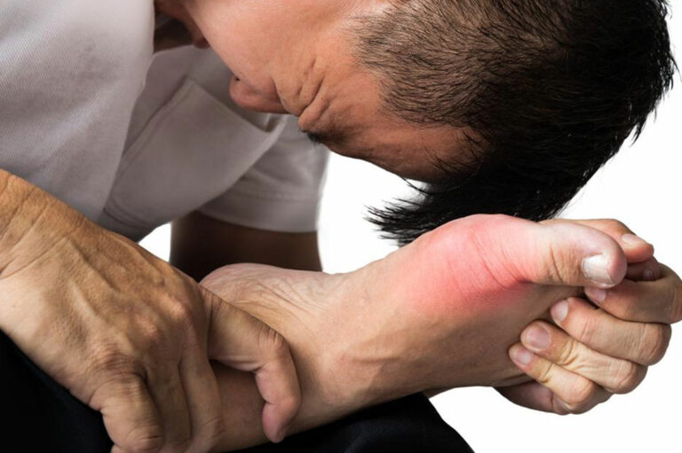 Different Treatment Plans for Gout Pain Relief and Prevention of Gout Attacks