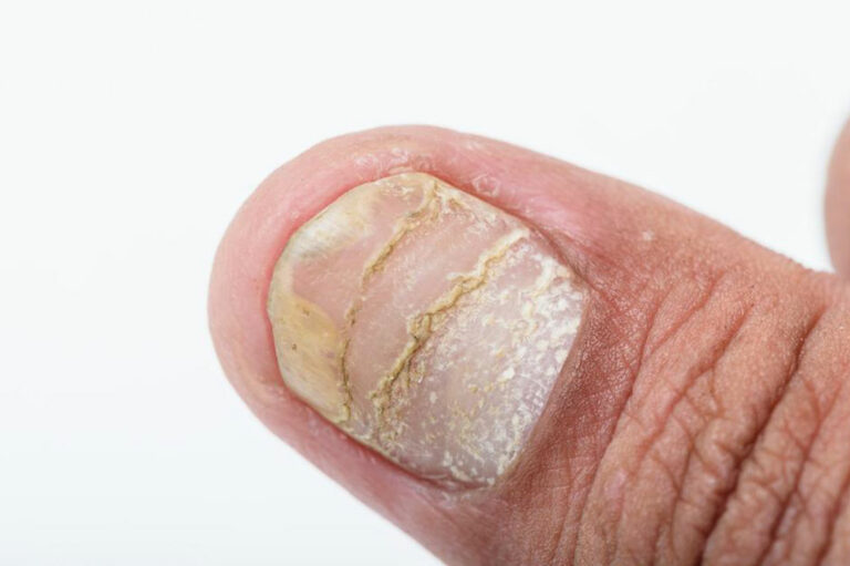 Different types of nail diseases and their causes