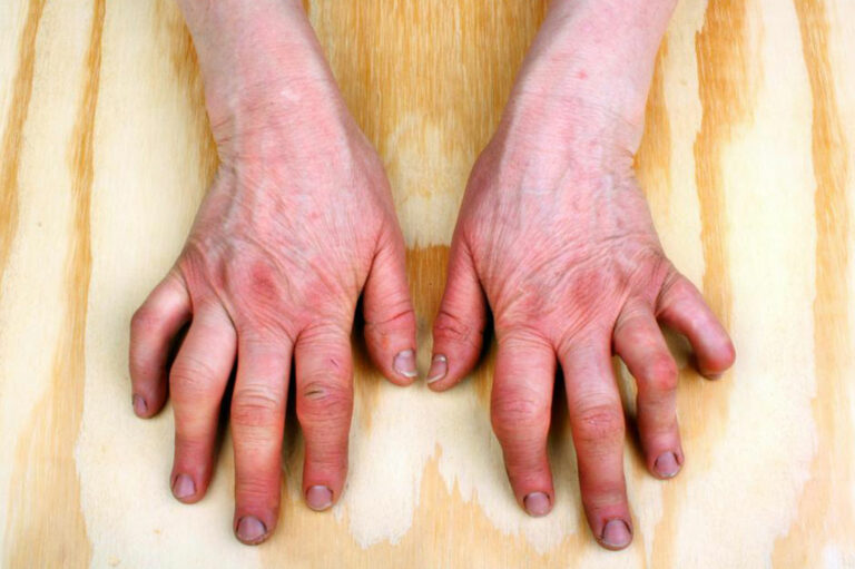 Do you have psoriatic arthritis symptoms