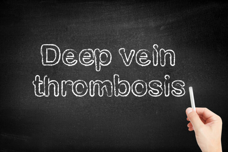 Everything to Know about Deep Vein Thrombosis