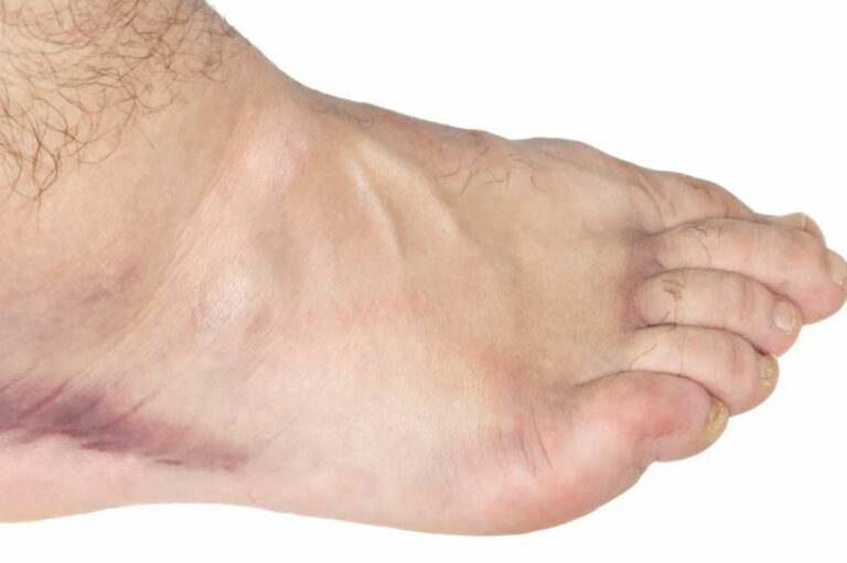 Exercises for swollen ankles treatment