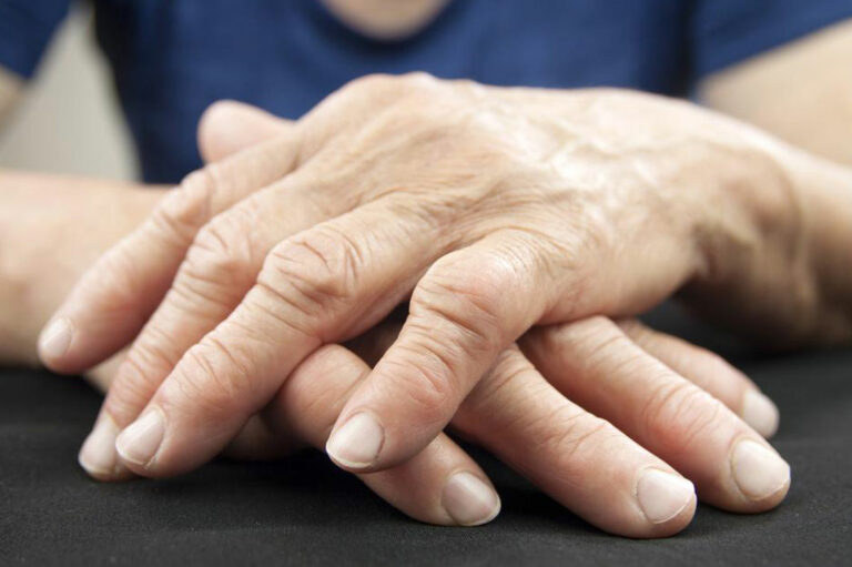 Easy Ways to Manage Psoriatic Arthritis