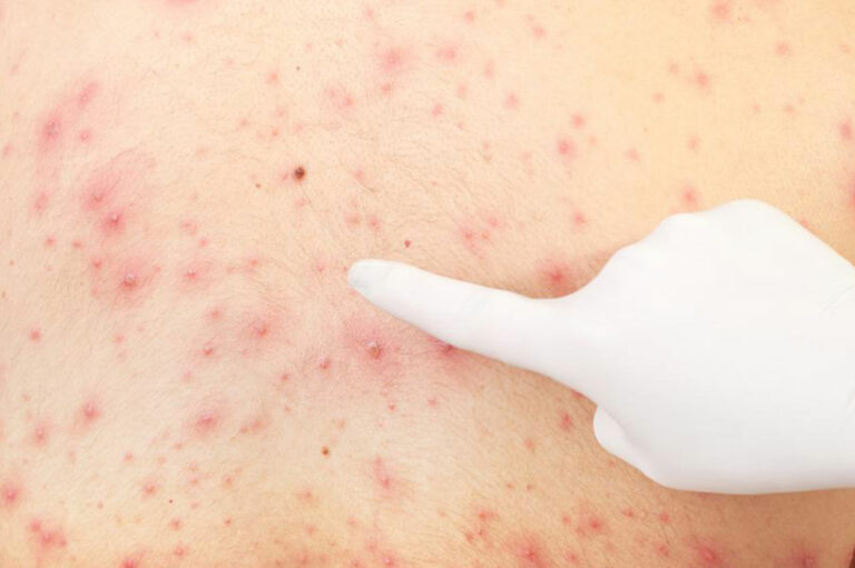 Effective Remedies for Treating Skin Rashes