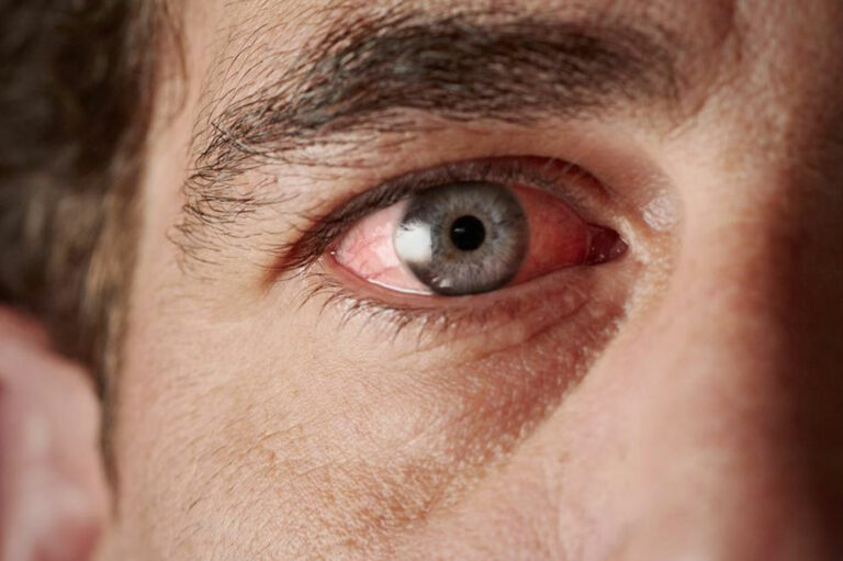 Effective Treatment Methods for Curing Red-eye