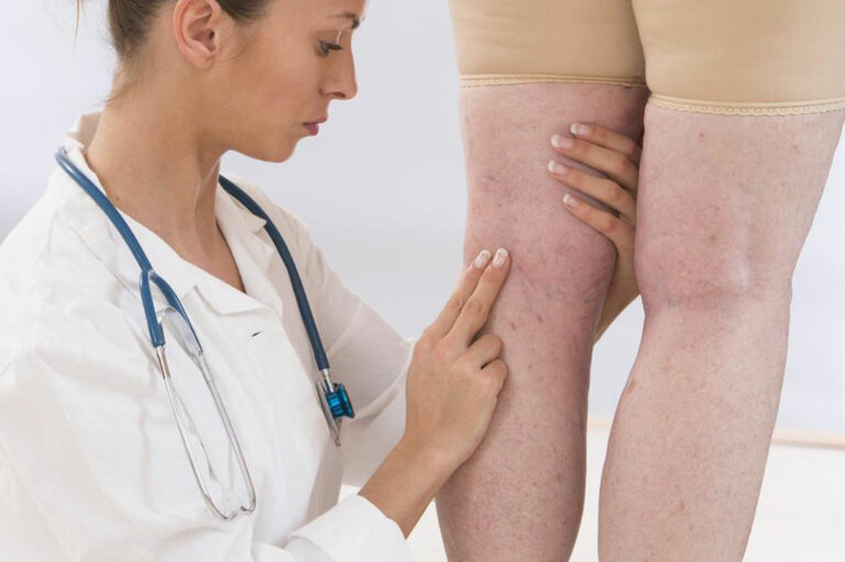 Effective Treatment for Varicose Veins